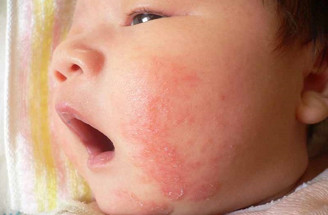 types of eczema, cause of eczema and genetic factors and environmental factors that trigger eczema. symptoms of eczema like rough skin, itchiness, treatment of eczema like moisturizing and bathing in Singapore and how to prevent eczema in Singapore