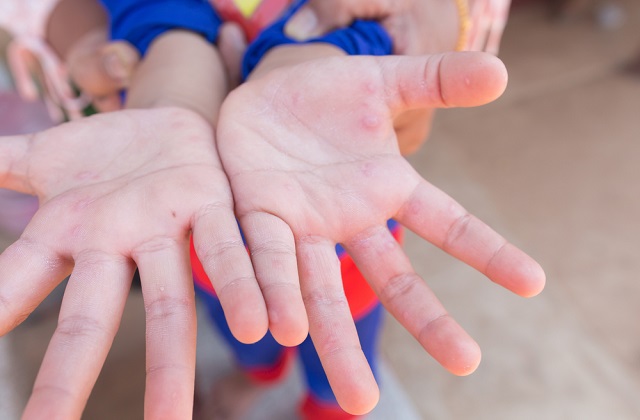  手足口症是一种由肠道病毒所引发的疾病。在新加坡，手足口症通常由科萨奇病毒以及71型肠病毒所引发。这里详细介绍手足口症的发病原因， 症状，以及家长可以采取的预防措施。 同时， 这里也介绍了家长可以采取的一些应对措施